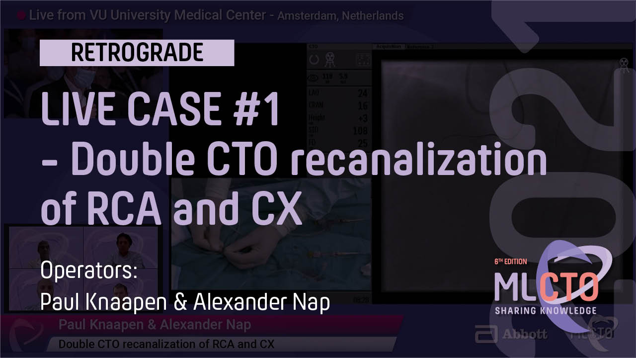 Double CTO recanalization of RCA and CX