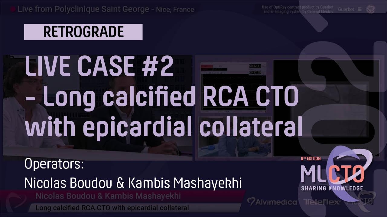 Long calcified RCA CTO with epicardial collateral