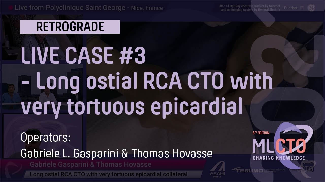 Long ostial RCA CTO with very tortuous epicardial collateral