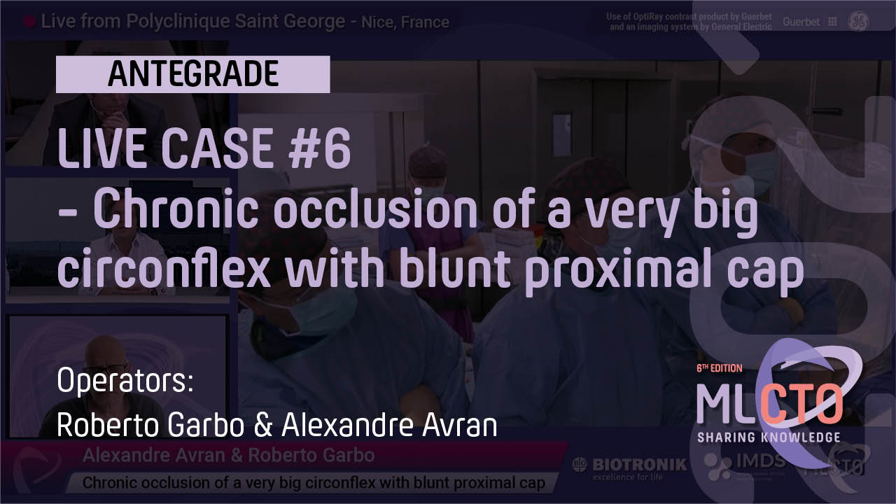 Chronic occlusion of a very big circonflex with blunt proximal cap