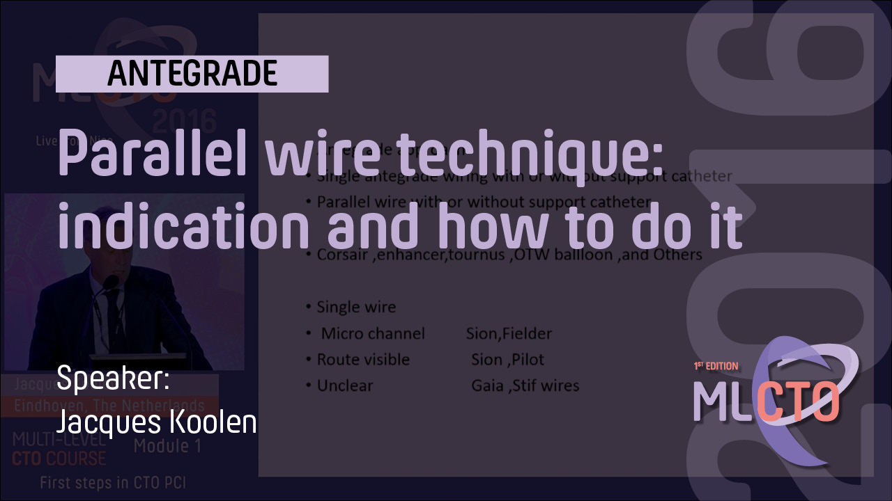 Parallel wire technique: indication and how to do it | MLCTO Academy