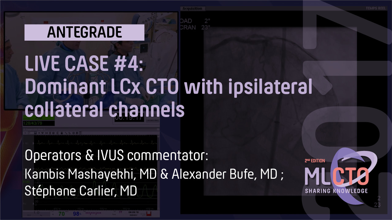 LIVE CASE #4 / ML CTO 2017