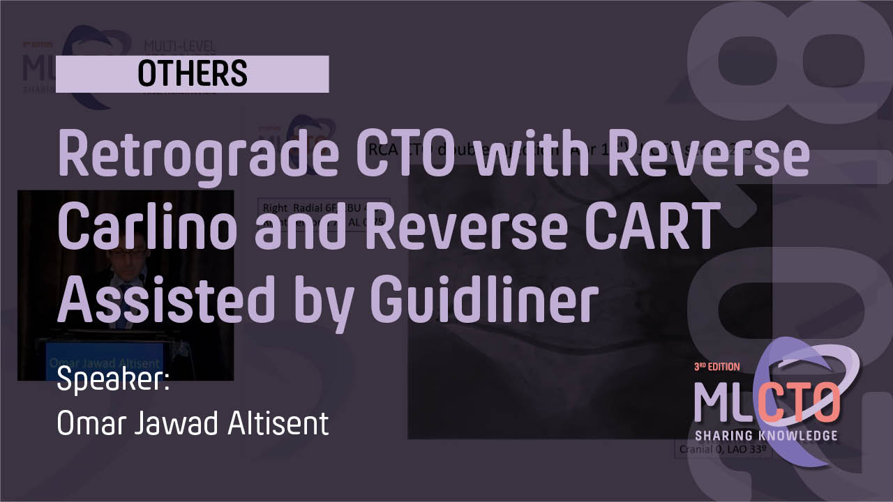 Retrograde CTO with Reverse  Carlino and Reverse CART Assisted by Guidliner