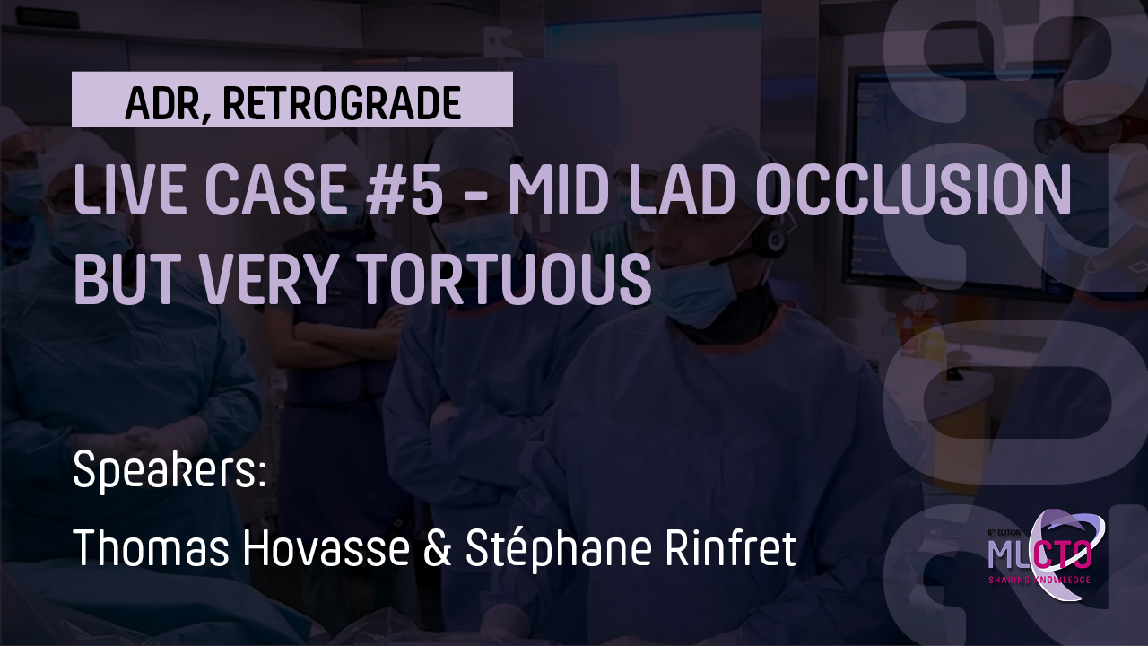 LIVE CASE #5 – MID LAD OCCLUSION BUT VERY TORTUOUS 
EPICARDIAL