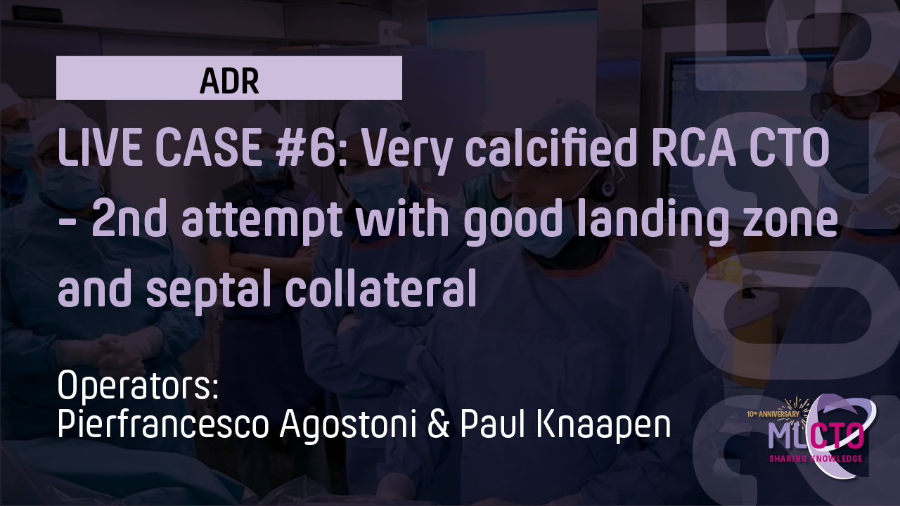 LIVE CASE #6 : Very calcified RCA CTO – 2nd attempt with good landing zone and septal collateral