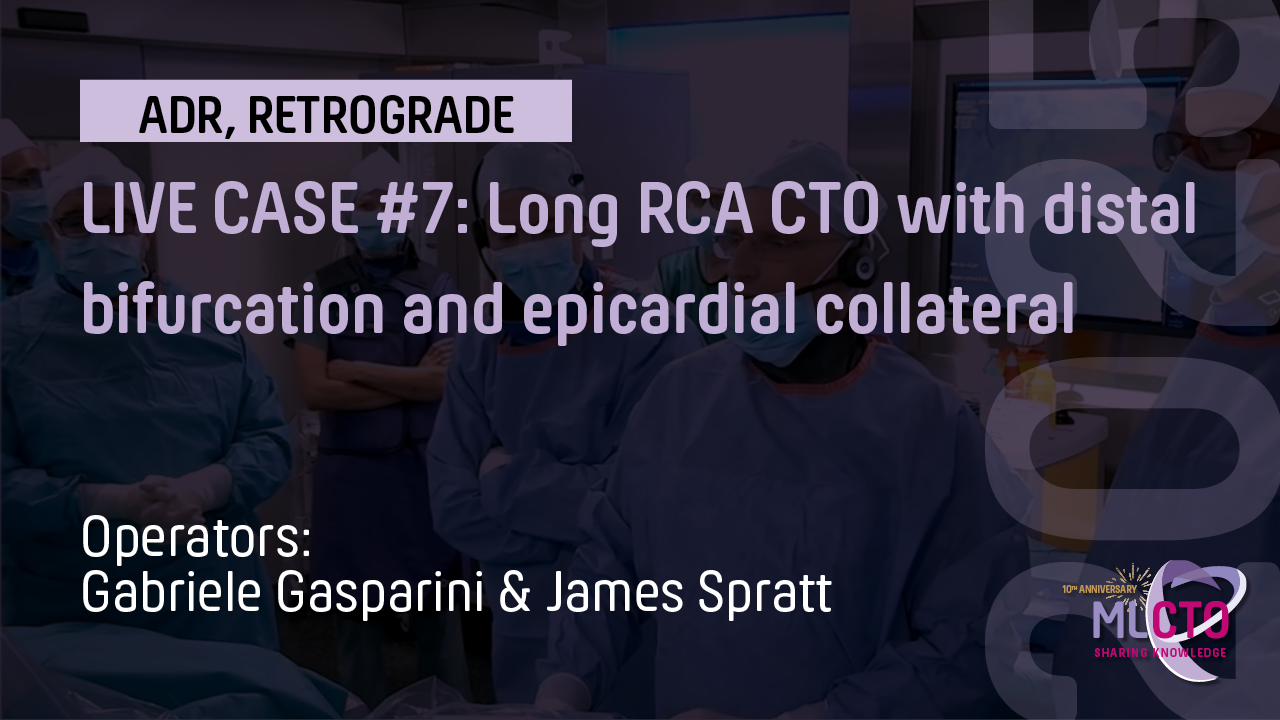 LIVE CASE #7 : Long RCA CTO with distal bifurcation and epicardial collateral